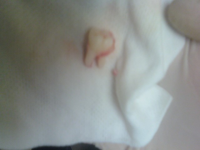wisdomtooth1.jpg